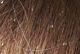 This Is What Nits Look Like In The Hair There S About 20 Nits In This Picture Lice Eggs Lice Nits Head Louse