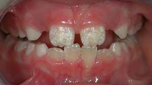 White Spots On Teeth 11 Tips On How To Get Rid Of Them