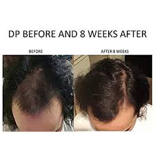 The procedure of a keratin hair treatment is carried out as. Buy New Improved Spare My Hair Conditioner Hair Loss Treatment Supports Faster Thicker Hair Growth Contains Yucca Extract Horsetail Saw Palmetto Jojoba Multi Vitamins Keratin Protein Online In Indonesia
