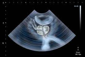 Una prostata ingrossata può far male ai testicoli? Cosa Fare Per Una Prostata In Salute Fondazione Umberto Veronesi