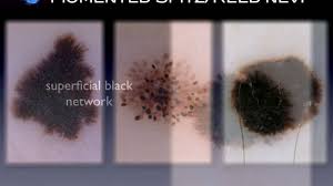 Image result for Spitz Nevus