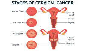 Cervical cancer occurs in the cells of the cervix—the lower part of the uterus that connects to the vagina. Make Cervical Health A Priority Aapc Knowledge Center
