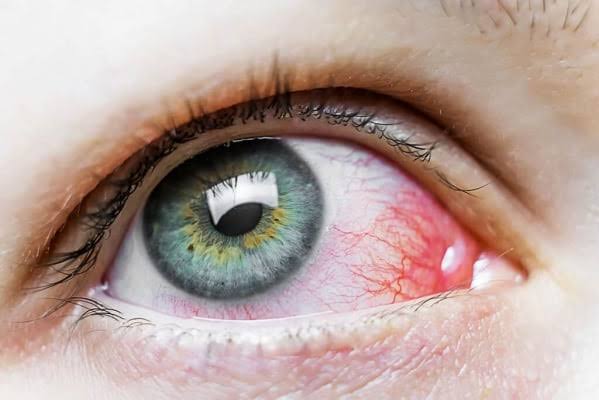 Các dấu hiệu mắt đỏ cần được bác sĩ chuyên khoa đánh giá