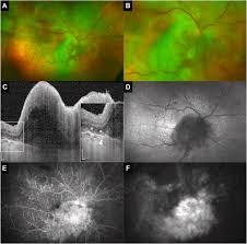 Secondary vitreoretinal lymphoma with spontaneous regression