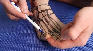 5.4k views answered >2 years ago. Sprained Pinky Toe Or Broken Pinky Toe Diagnosis Best Treatment