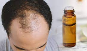 If yes, use tea tree oil for hair in these 11 effective ways and see the clear results in a few weeks. Hair Loss Treatment Using Tea Tree Essential Oil Could Help Increase Hair Growth Express Co Uk