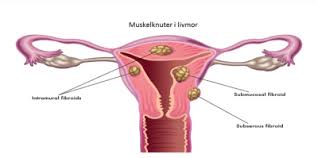 Slike årsaker kan være kobberspiral, endometriose eller muskelknuter i livmoren. Ann Linda Myomer