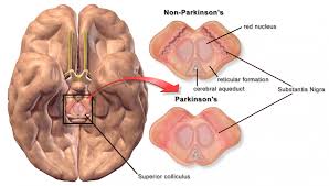 The same clinical condition can be triggered by rapid discontinuation of dopaminergic medication in parkinson's disease. Atypical Parkinsonism Diagnosis Symptoms And Treatment