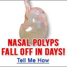I have shared in detail nasal polyps treatment at home without operation or surgery | anam home remedy you must try this remedy after consulting your doctor. Cure Nasal Polyps Naturally Home Facebook