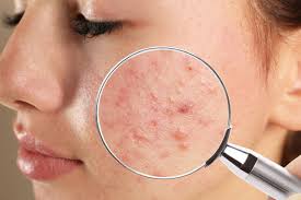 Apa Penyebab Jerawat Membandel di Wajah? Ini Kata Dokter