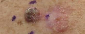 According to the american cancer society, just over 100,000 new cases of skin cancer are diagnosed in the united states each year. Squamous Cell Carcinoma Wikipedia