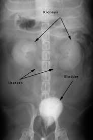 Image result for Intravenous Pyelogram