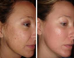 Le peeling visage contre l'acné. Peeling Visage Tout Ce Qu Il Faut Savoir Sur Le Prix Types Et Techniques Du Peeling Cicatrices Acne Peeling Visage Cicatrice