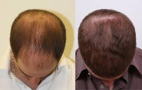 Msm is necessary for the production of keratin and for repairing the broken structure of keratin in your hair. Msm For Hair Growth Does It Really Work No More Hair Loss Problem