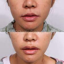 Pin On Facelift