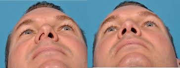 A deviated septum occurs when your nasal septum is significantly displaced to one side, making one nasal air passage smaller than the other. Deviated Septum Septoplasty Pacific Eye Ear Specialists