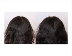 Hair loss doesn't have to hold you back. 51 Female Hair Loss Results Before And After Hairmd Pune Ideas Prp For Hair Loss Hair Loss Pictures Female Pattern Baldness