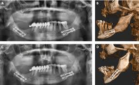 Image result for Coronoid Process Fracture