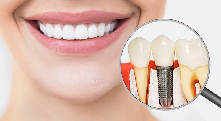 Dental Implants in New York, NY | Dental Implants Near Me