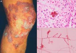 Aparición de nuevos agentes patógenos, de cepas resistentes, de procesos con expresión. Afectacion Cutanea En Las Micosis Profundas Una Revision De La Literatura Parte 1 Micosis Subcutaneas Sciencedirect