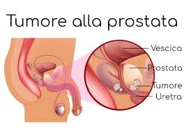 Alimenti contro la prostatite cronica y. Tumore Alla Prostata Sintomi E Sopravvivenza
