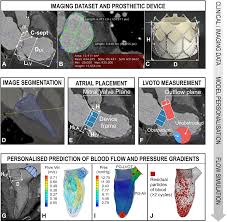 Image result for Left Ventricular Outflow Obstruction
