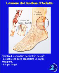 In uno studio, l'85 per cento delle rotture del tendine d'achille sono causate da una condizione chiamata tendinosi (o tendinite) cioè zone morte di tessuto all'interno del. Rottura Del Tendine D Achille I Sintomi E La Riabilitazione