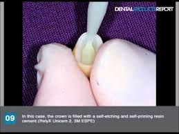 When prepping a tooth for a posterior zirconia crown, you will need to ensure that there is sufficient room for the wall thickness to have a minimum of 0.5 mm and ideally between 1 mm and 1.5 mm or 1.5 to 2 mm occlusal reduction. Cement Selections For Zirconia Other Restoratives Youtube