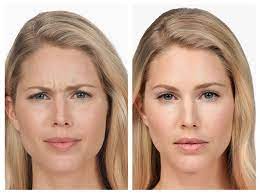Botox Injections Best Botox Specials Cheapest Botox In Santa Barbara Botox Botox Injections Facial Muscles