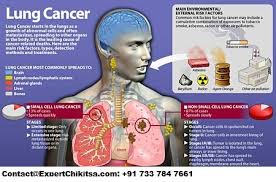 Smoking is widely considered the leading cause of lung cancer. Lung Cancer Diagnosis Treatment And Cost Expert Chikitsacontact Now