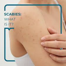 Image result for scabies symptoms
