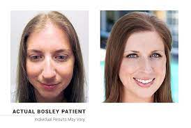 The price depends on several factors like the severity of baldness, the type of hair, etc. How Much Does A Hair Restoration Cost Hair Transplant Women Hair Transplant Hair Transplant Cost