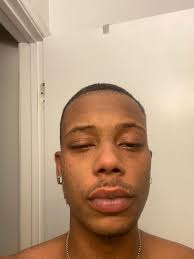 Cluster Headache Relief and Treatment Options