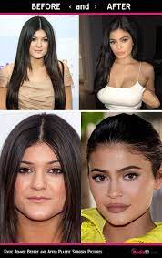 Kylie jenner is one of the world's most popular celebrities. Die 13 Besten Ideen Zu Prominente Plastische Chirurgie Prominente Plastische Chirurgie Prominente Nasenkorrektur