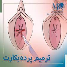 آیا پرده بکارت خود به خود ترمیم می‌شود+هزينه ترميم بكارت با ليزر سال 1404