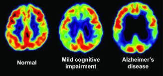 Kết quả hình ảnh cho Bệnh mất trí nhớ: Alzheimer & Dementia.