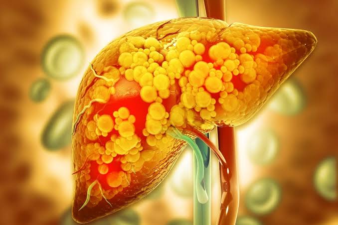 India Faces Rising Burden of Fatty Liver and Colorectal Cancer Alongside Persistent Gastrointestinal Diseases