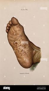 Image result for pompholyx soles of feet