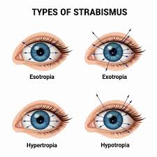 Image result for Strabismus