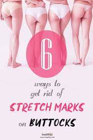 Pin On Stretch Marks
