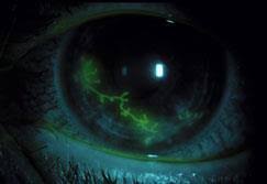 Furthermore, we have shown that an 8mer (itayglvl). Herpes In Your Eye Sightmd