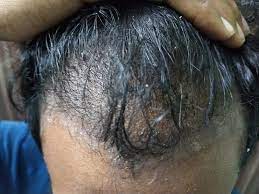 'psoriasis is often confused with another severe. Aren T You Worried About Scalp Psoriasis