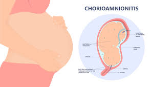 Image result for Chorioamnionitis