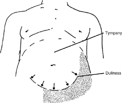 Image result for Shifting Dullness Test