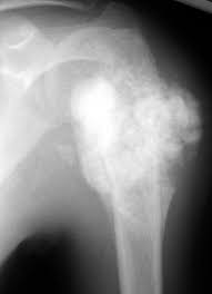 Image result for Osteosarcoma
