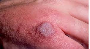 Wir haben uns die daten um den mult. Was Sind Die Ersten Symptome Von Mrsa