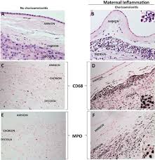 Image result for Chorioamnionitis