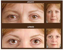 1 it has also become popular among dermatologists and plastic surgeons for its cosmetic indications to temporarily. Toxine Botulique Botox Body Mind Soulbody Mind Soul