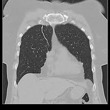 Image result for Atelectasis