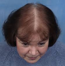 You may have lost your hair gloss and texture with the growing age. Rawatan O Hairstyle For Female Pattern Baldness